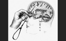 Lobotomie: Hirn-OPs für psychische Gesundheit?