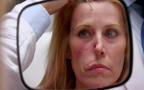 Verpfuscht - Ein Fall für die Beauty Docs 
 Mehr Narbe als Busen